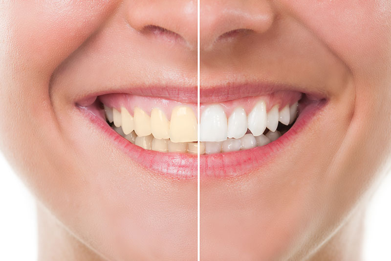 Teeth Whitening in Gurnee